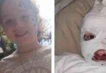 Recalled Temu Jumper: Skin Falling Off Girl Burnt Incident (80 characters) recalled-temu-jumper-skin-falling-off-girl-burnt-ncident-80-characters