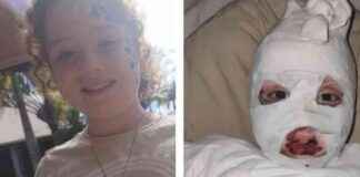 Recalled Temu Jumper: Skin Falling Off Girl Burnt Incident (80 characters) recalled-temu-jumper-skin-falling-off-girl-burnt-ncident-80-characters