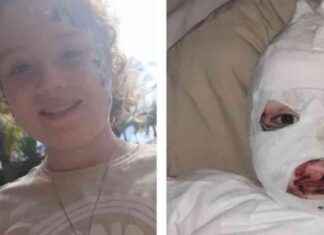 Recalled Temu Jumper: Skin Falling Off Girl Burnt Incident (80 characters) recalled-temu-jumper-skin-falling-off-girl-burnt-ncident-80-characters